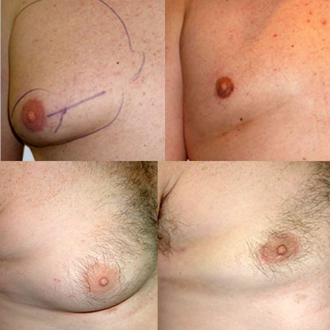 Male Breast Reduction Surgery (Gynecomastia) 
