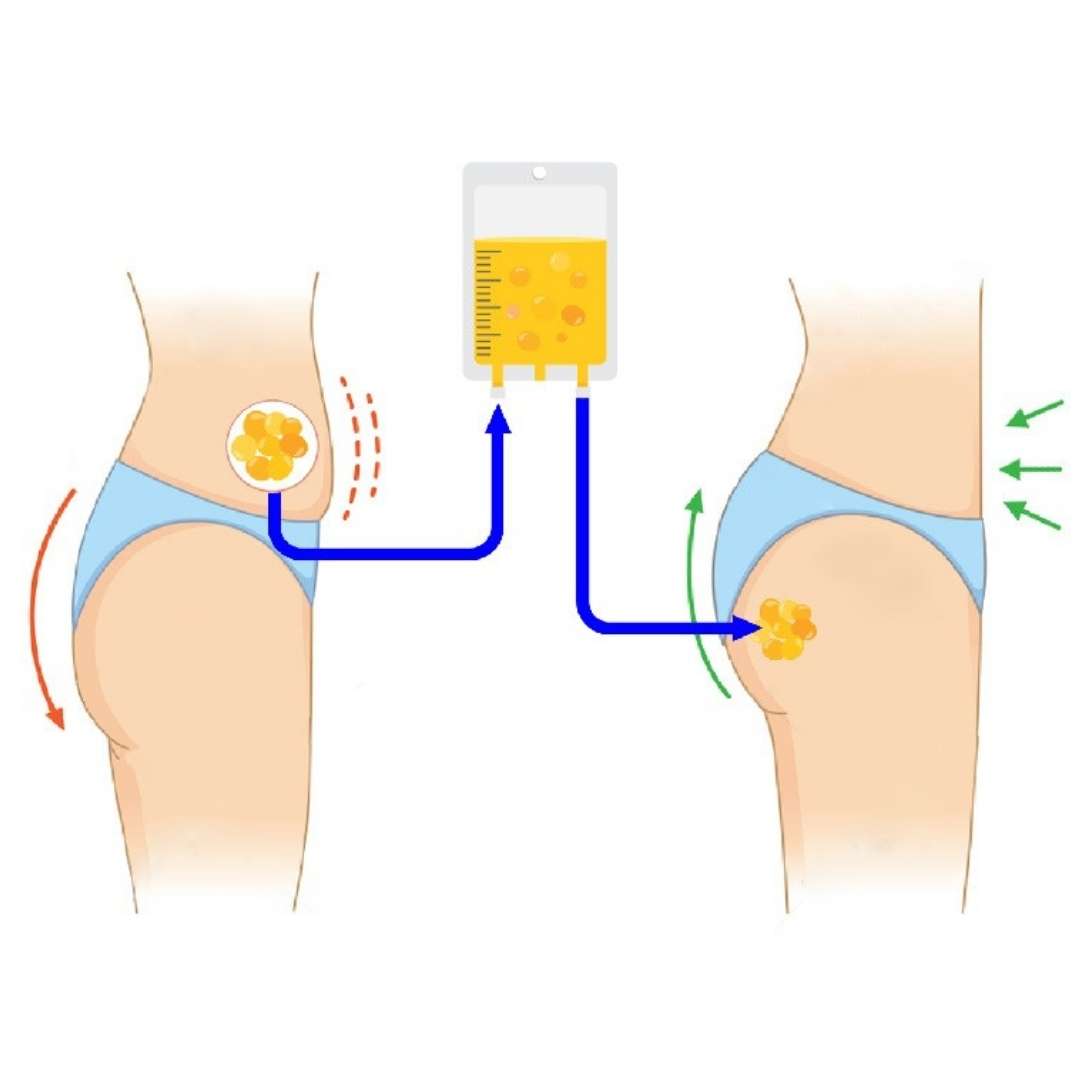 Fat Transfer: Natural Process of Enhancing Body Contours