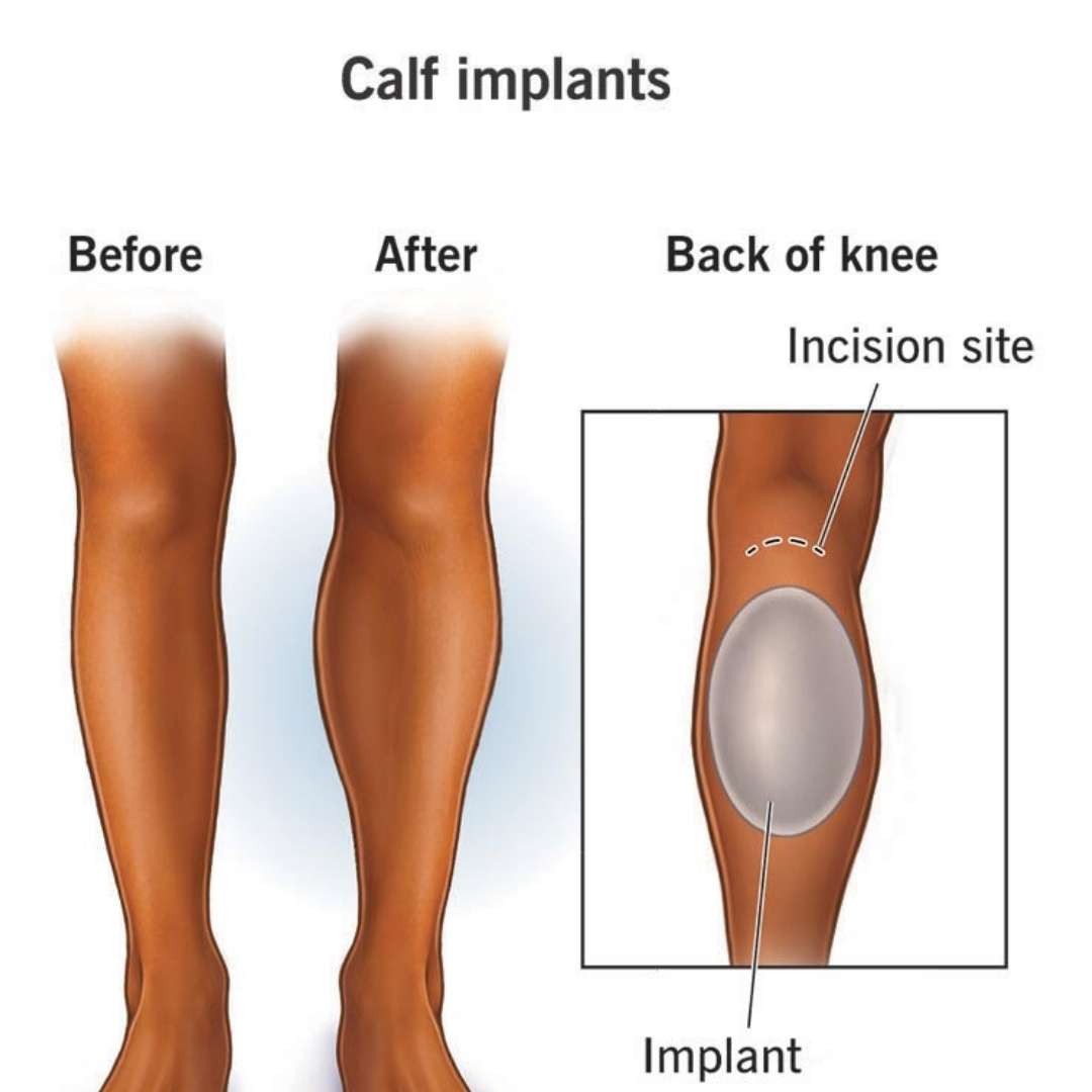 Calf Implant Surgery